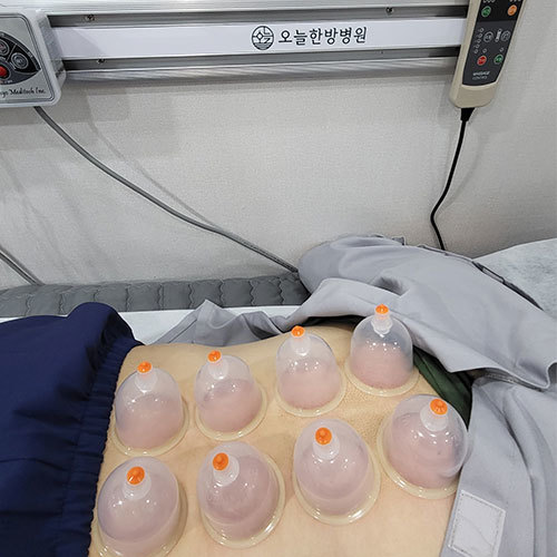 부항 치료
